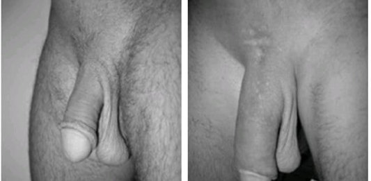 operatie-marirea-penisului-4